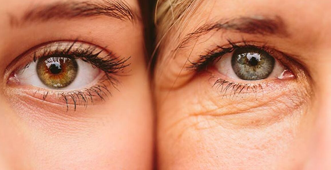 Ārējās ādas novecošanās pazīmes ap acīm divām dažāda vecuma sievietēm