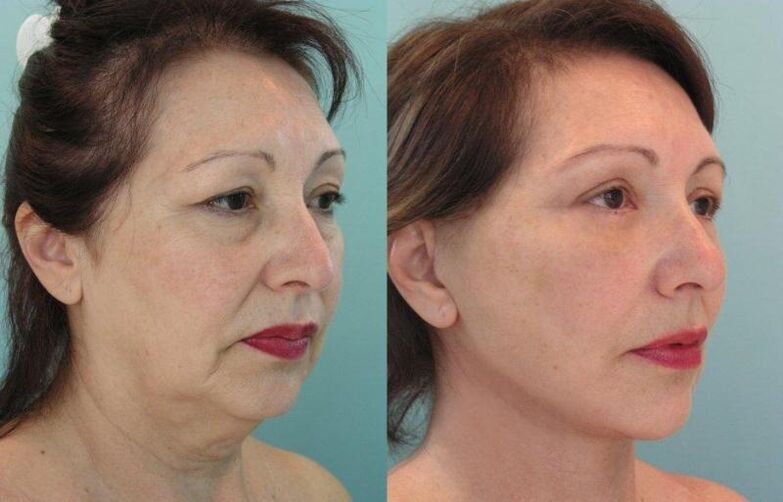 Atjaunojošas sejas ādas savilkšanas ar diegiem rezultāts